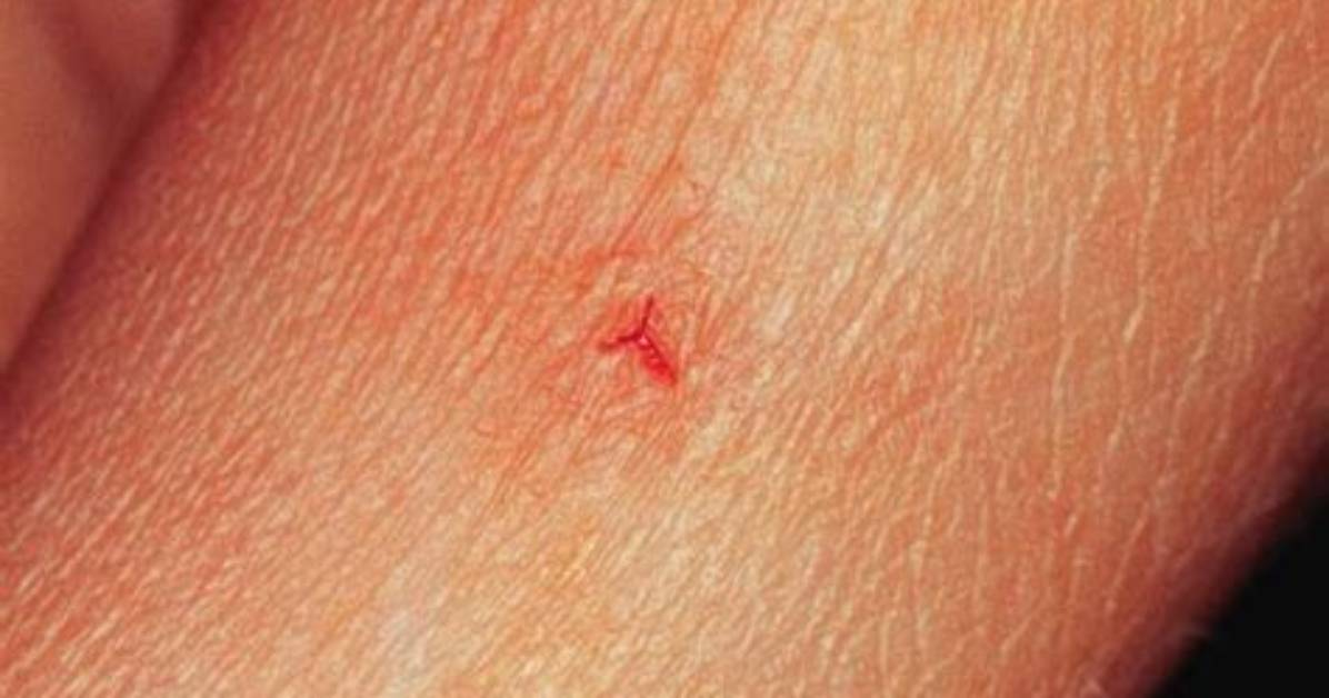 Are Triangular Wounds Impossible to Stitch