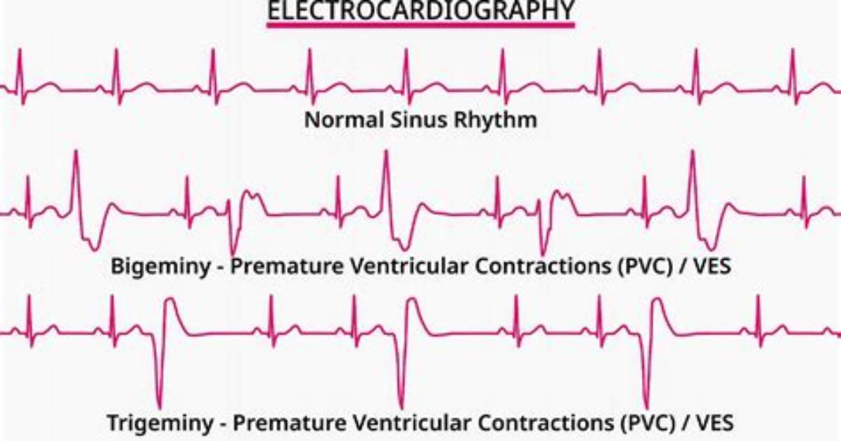 Are Trigeminal Pvcs Dangerous?
