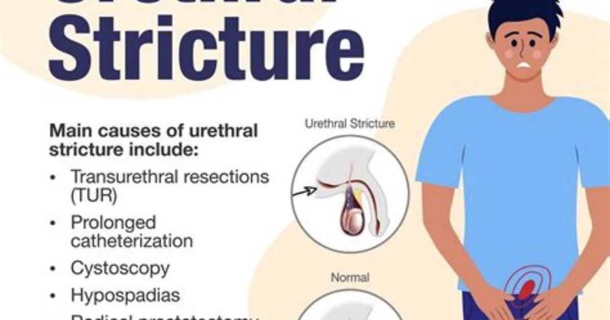 Are Urethral Strictures Common?