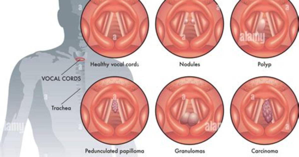 Are Vocal Nodules Common