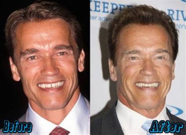 Arnold Schwarzenegger Plastic Surgery Before and After