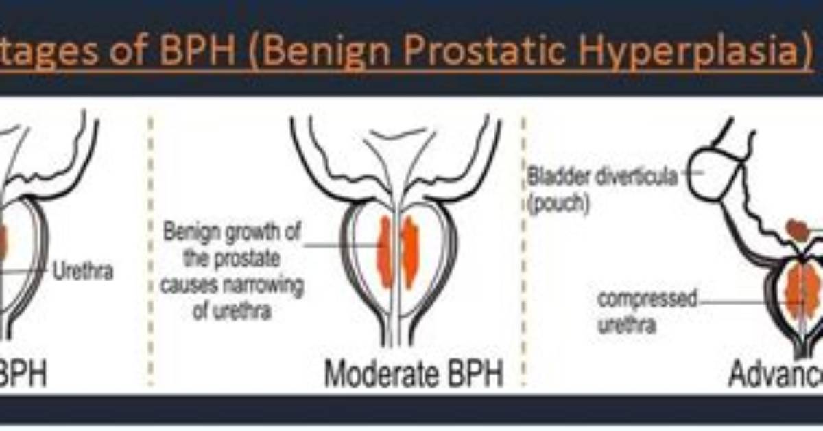 At What Age Does Bph Start?