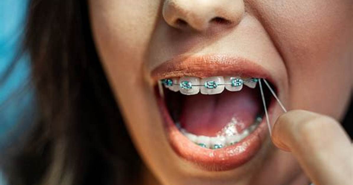 Braces Put on Wrong - How to Discuss