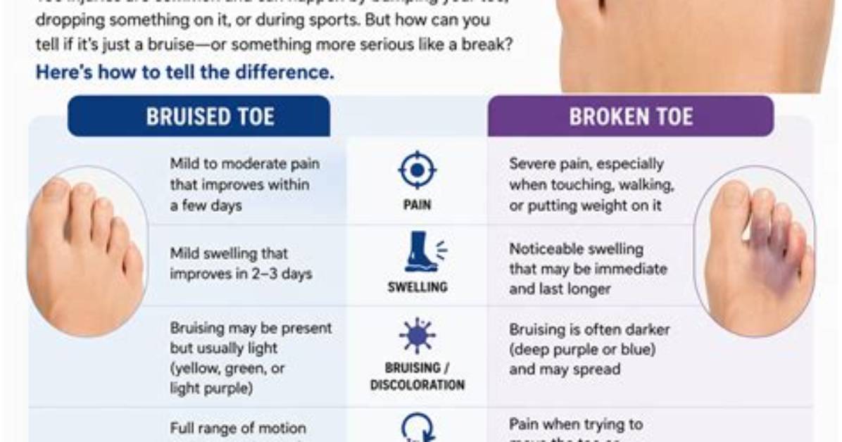 Bruised Toe - How to Discuss