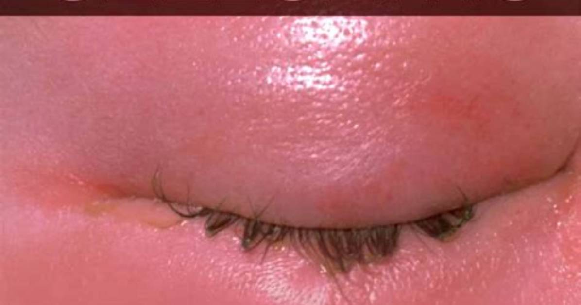 Can a Boil Cause Cellulitis