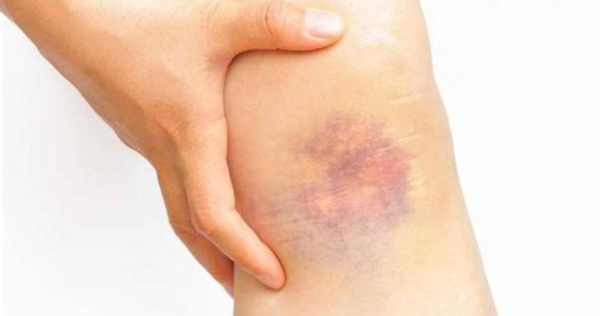 Can a Bruise Calcify?