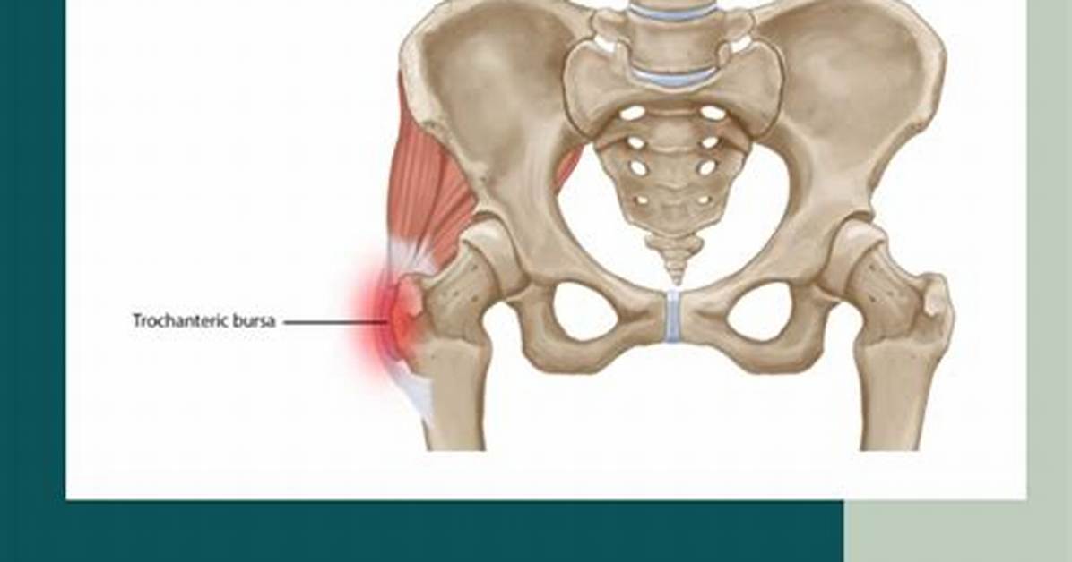 Can a Chiropractor Help with Trochanteric Bursitis?