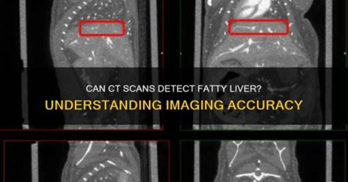 Can a Ct Scan Detect Liver Damage?