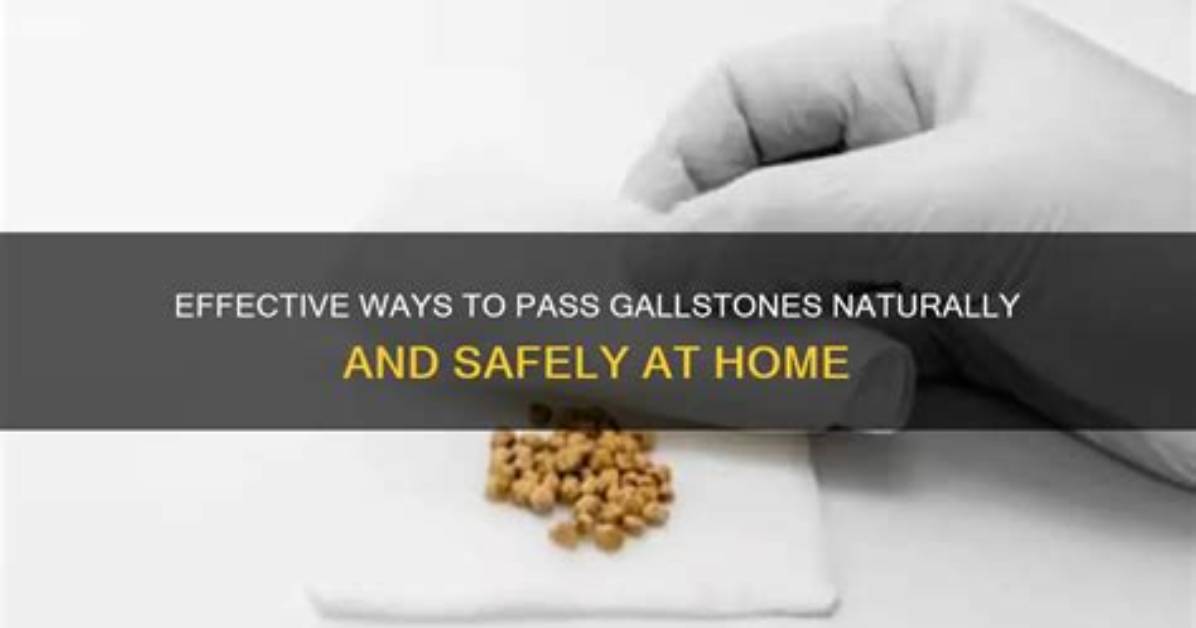Can a Gallstone Pass?