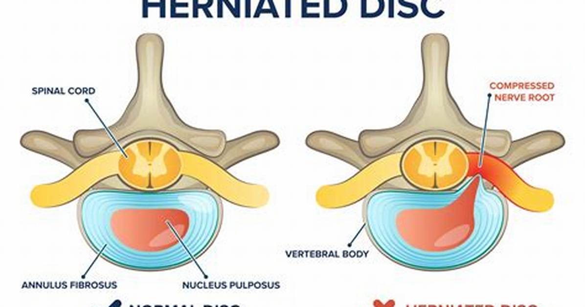 Can a Herniated Disc Heal After 2 Year's?