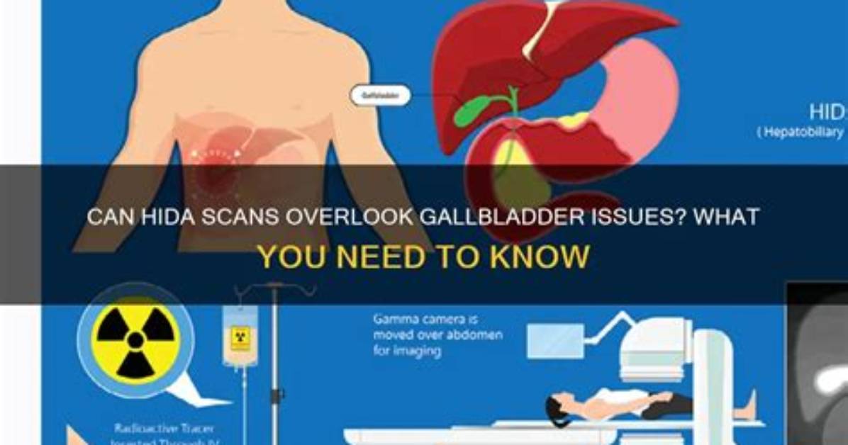 Can a Hida Scan Miss Gallbladder Problems