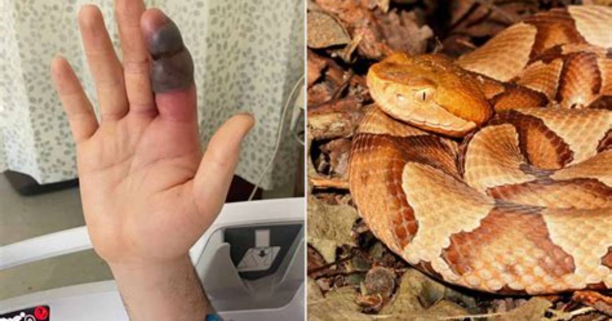 Can a Human Survive a Copperhead Bite?