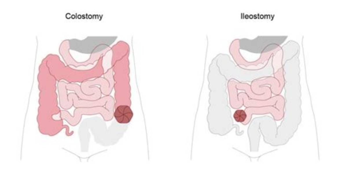 Can a Permanent Colostomy Be Reversed?