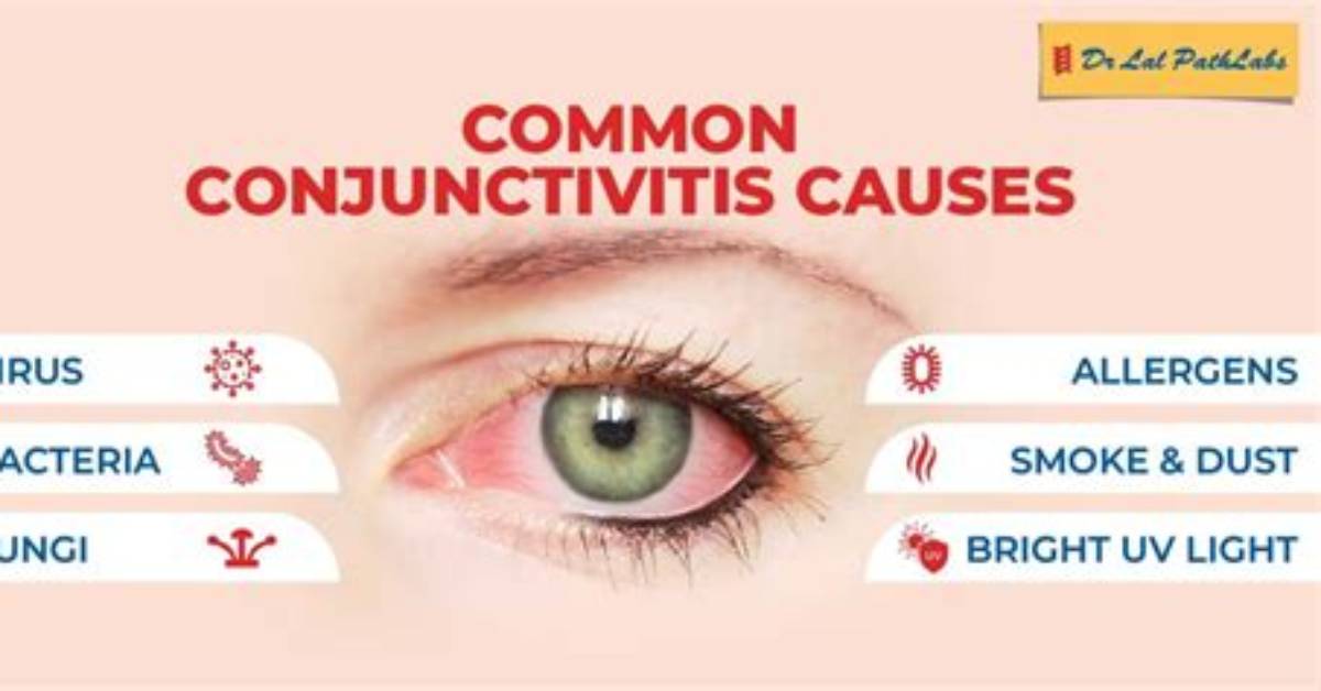 Can a Snotty Nose Cause Conjunctivitis?