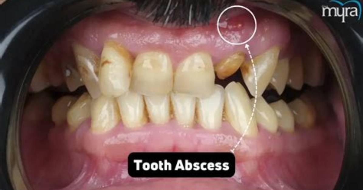 Can a Tooth Abscess Be Lanced?