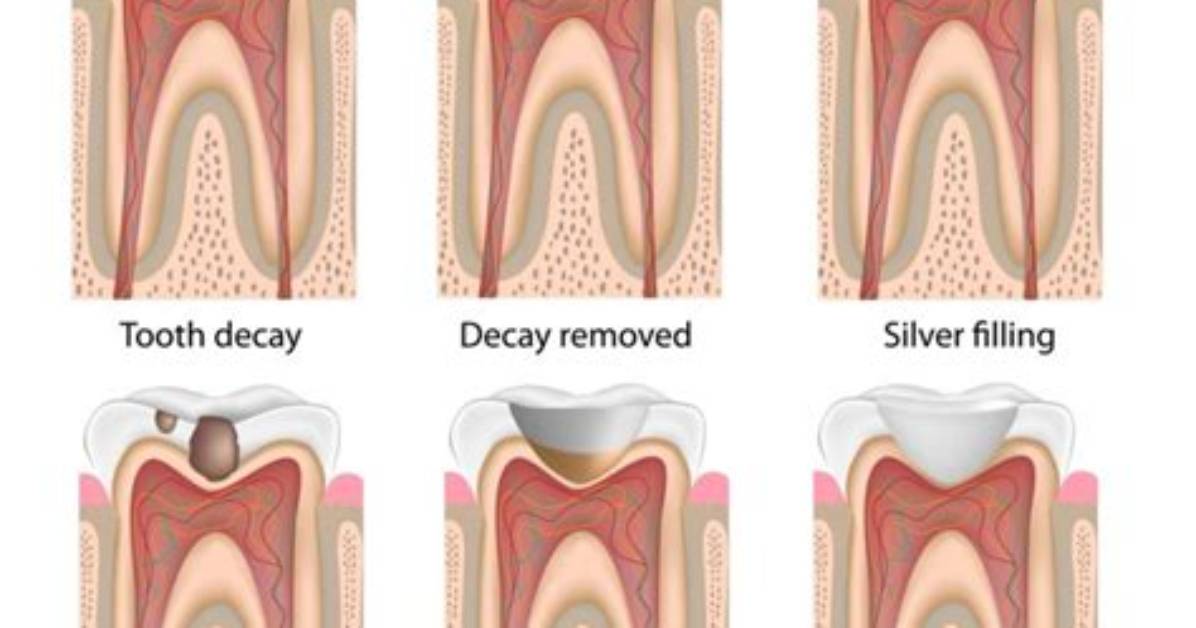 Can a Tooth Be Refilled?