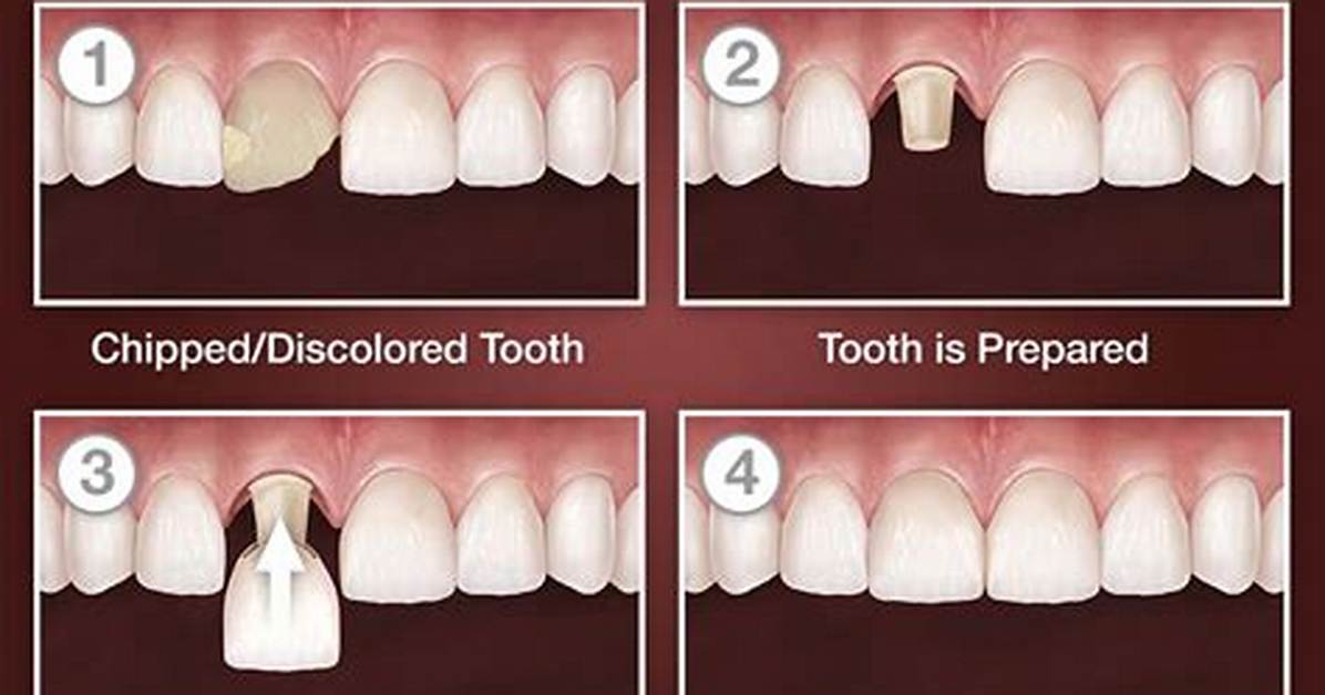 Can a Tooth with a Crown Get Infected?