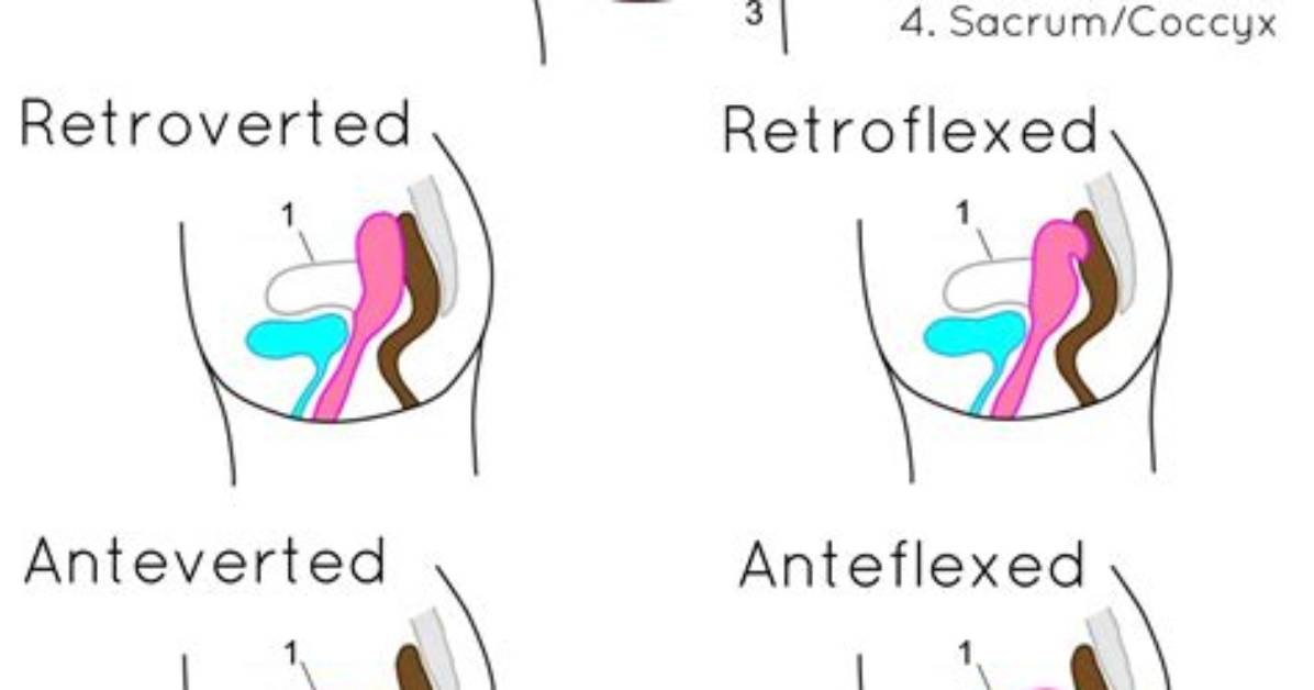 Can a Uterus Change Position
