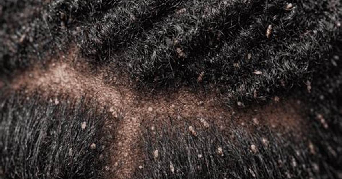 Can Afros Get Lice?