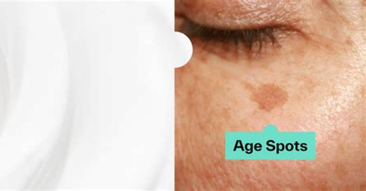 Can Age Spots Be Removed?