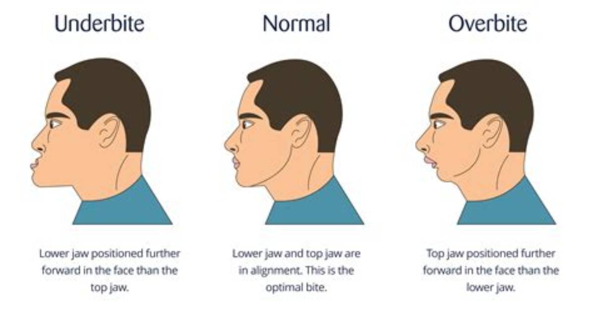 Can an Underbite Correct Itself?