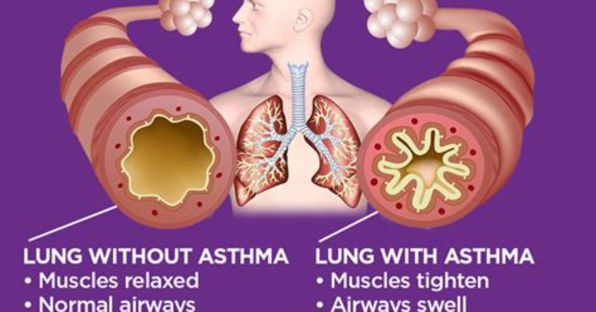 Can Asthma Cause Atopy?