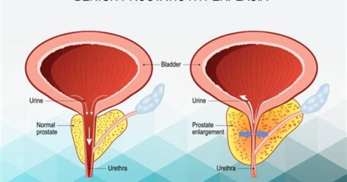 Can Benign Prostatic Hyperplasia Be Cured?