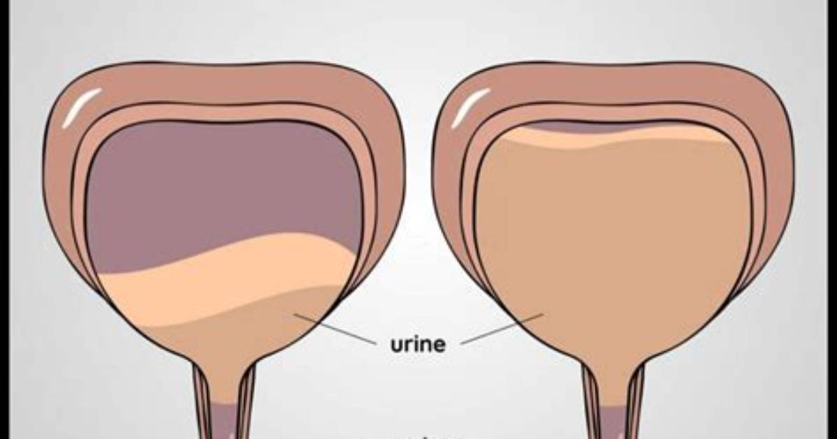 Can Birth Control Cause Overactive Bladder?