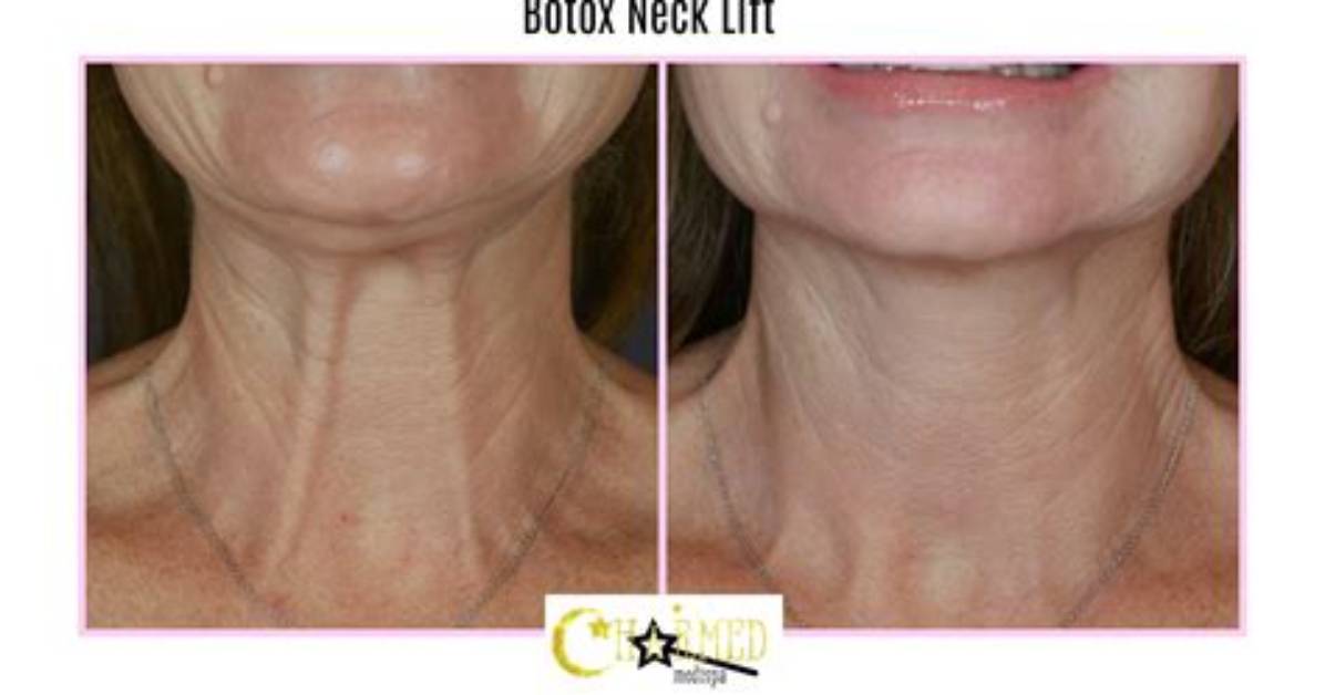 Can Botox Help Neck Bands?