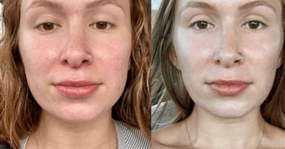 Can Botox Mess up Your Face?