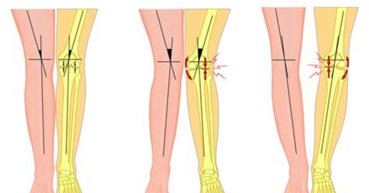 Can Bowleggedness Be Corrected?