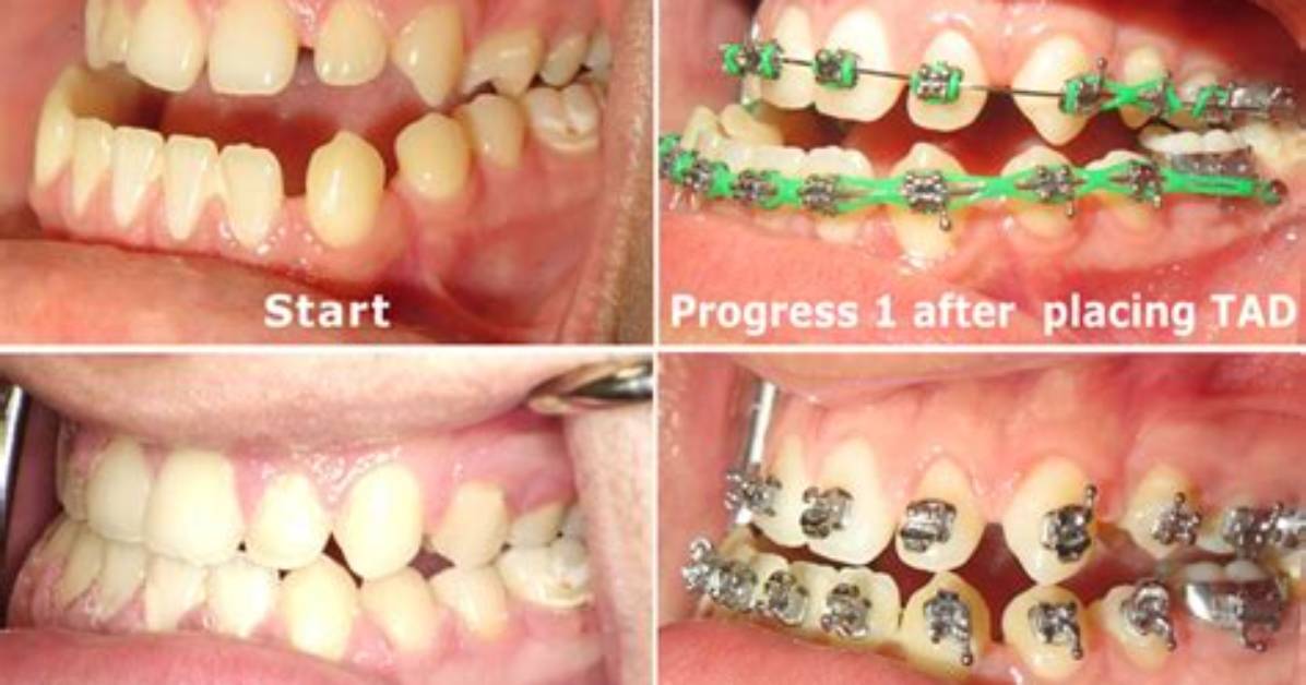 Can Braces Fix Underbite Without Surgery?