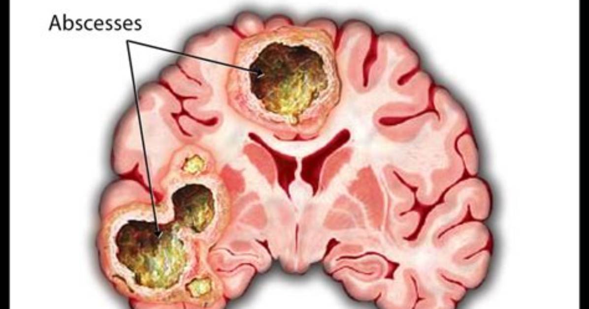 Can Brain Abscess Come Back?