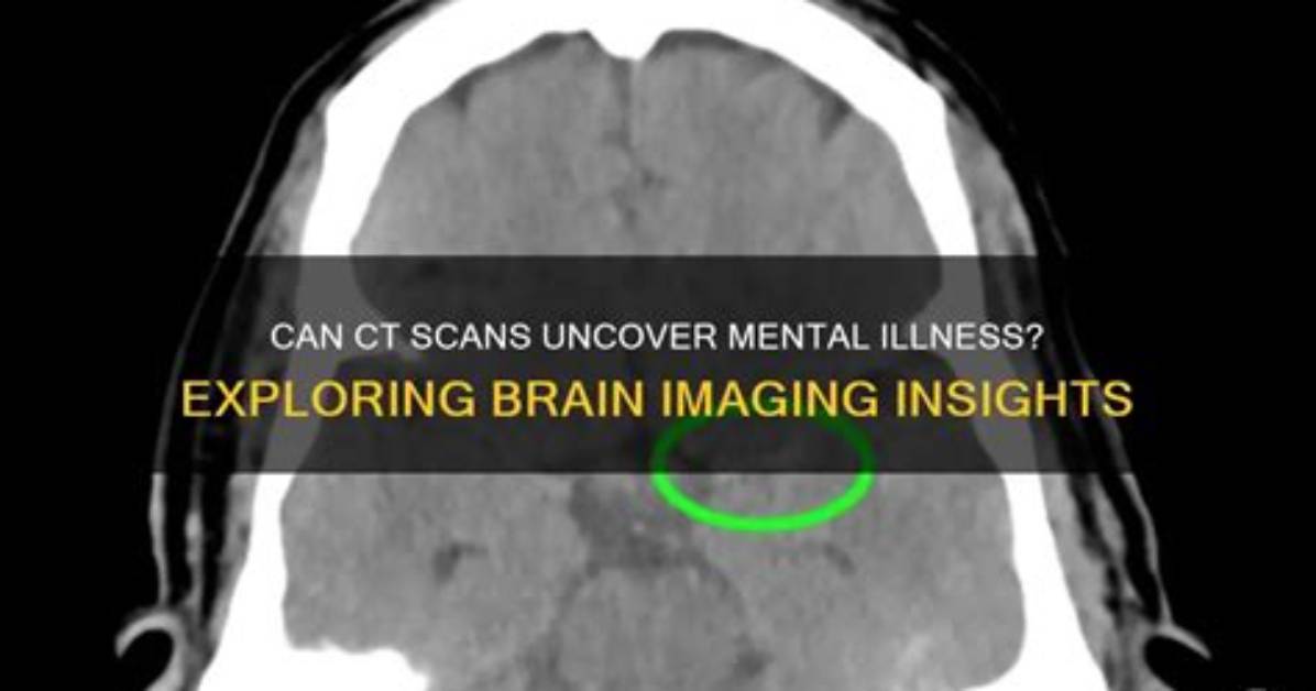Can Brain Scans Detect Mental Illness?