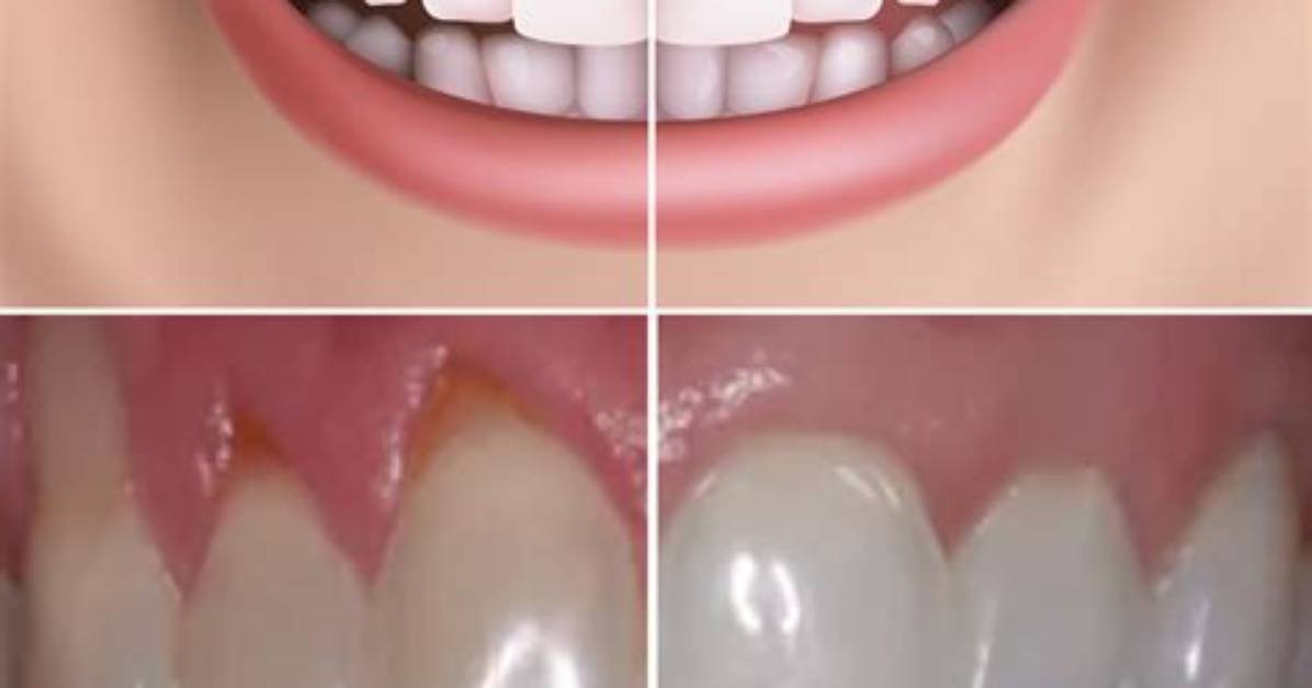 Can Brushing Stop Receding Gums?