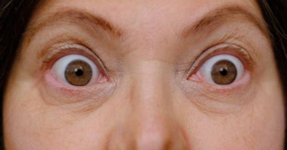 Can Bulging Eyes Be Corrected