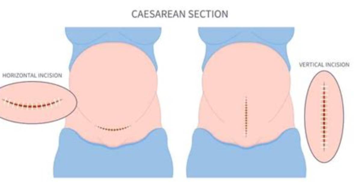 Can C Section Open from the Inside?