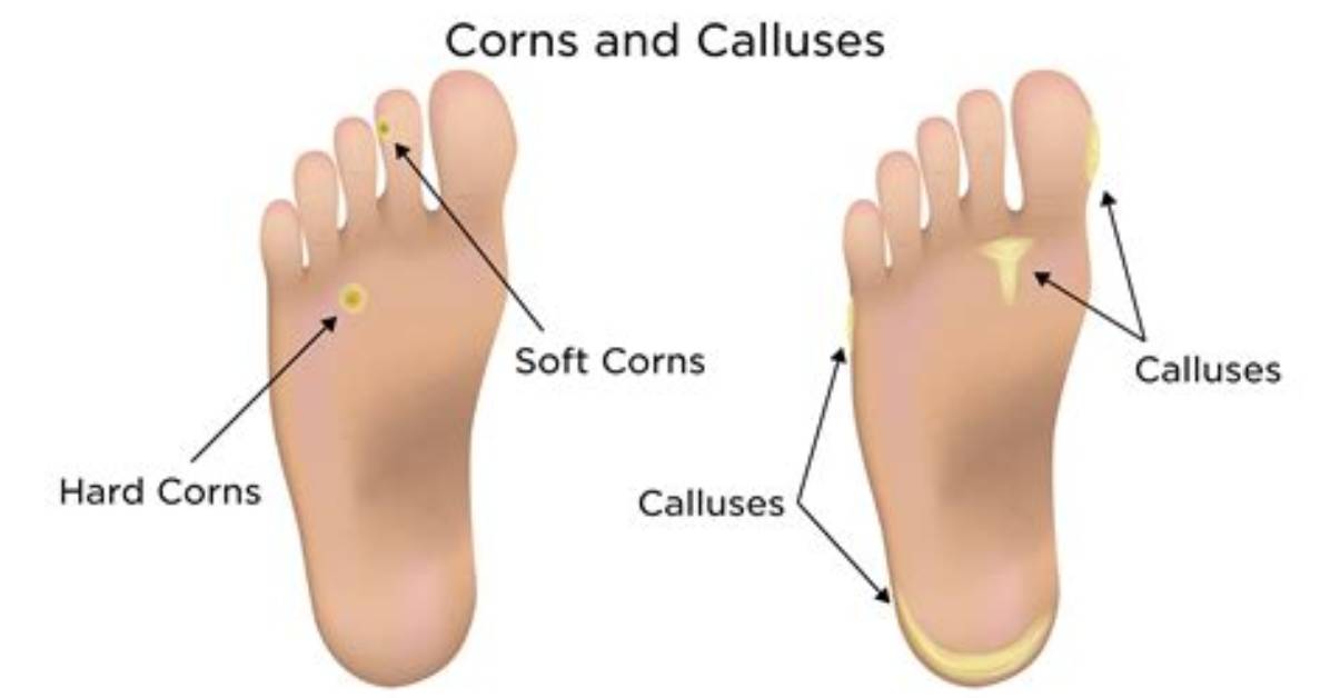 Can Calluses Go Away?