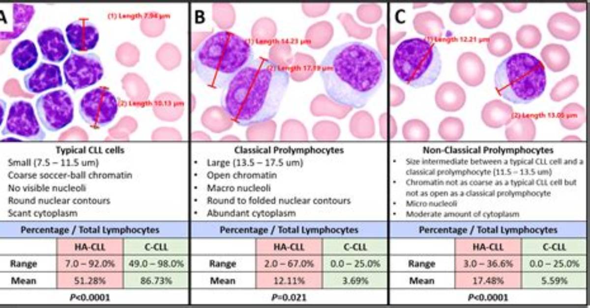 Can Cll Become Cml