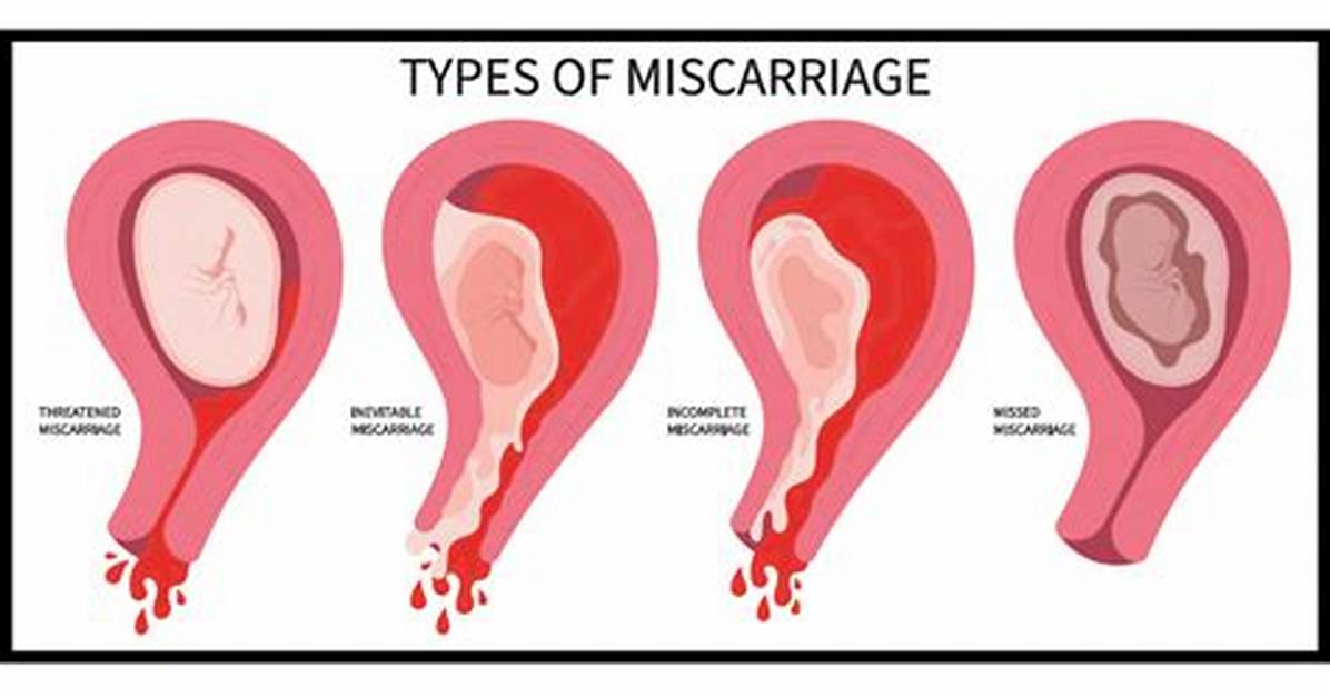 Can Clotting Cause Miscarriage?