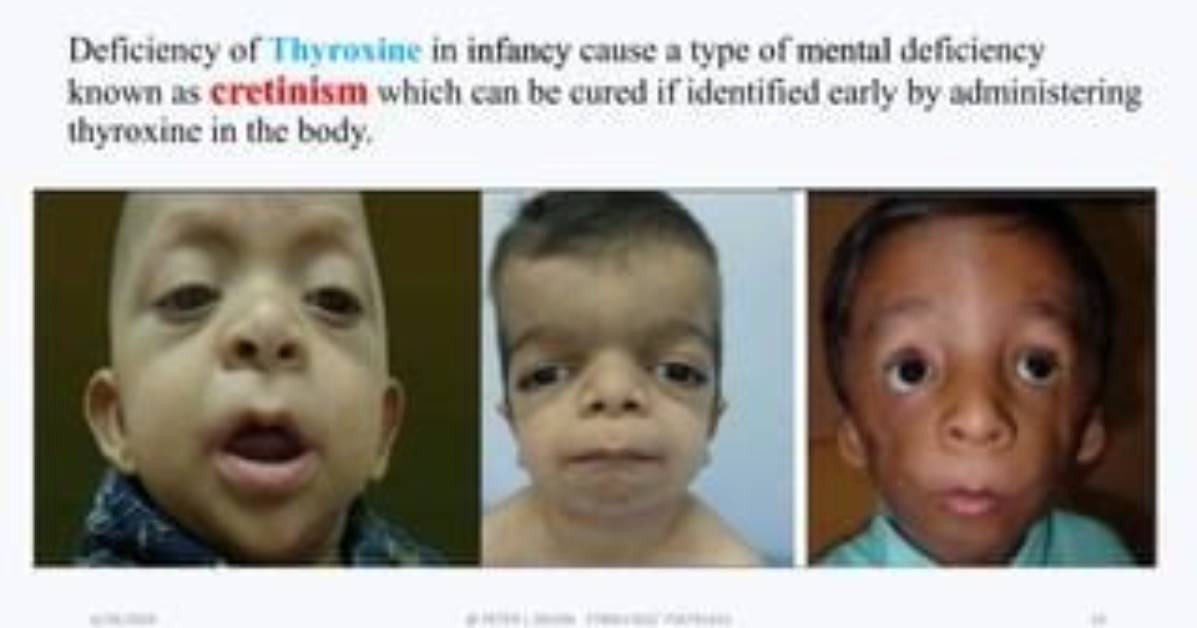 Can Cretinism Be Cured?