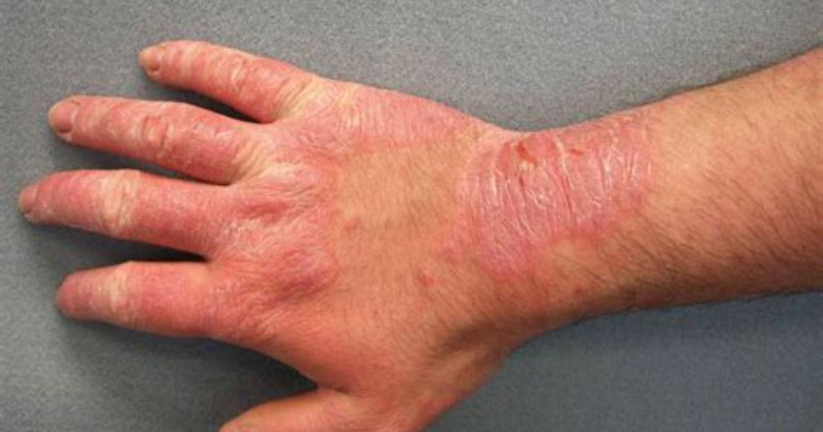 Can Dermatitis Cause Tingling? | Contextresponse. Com