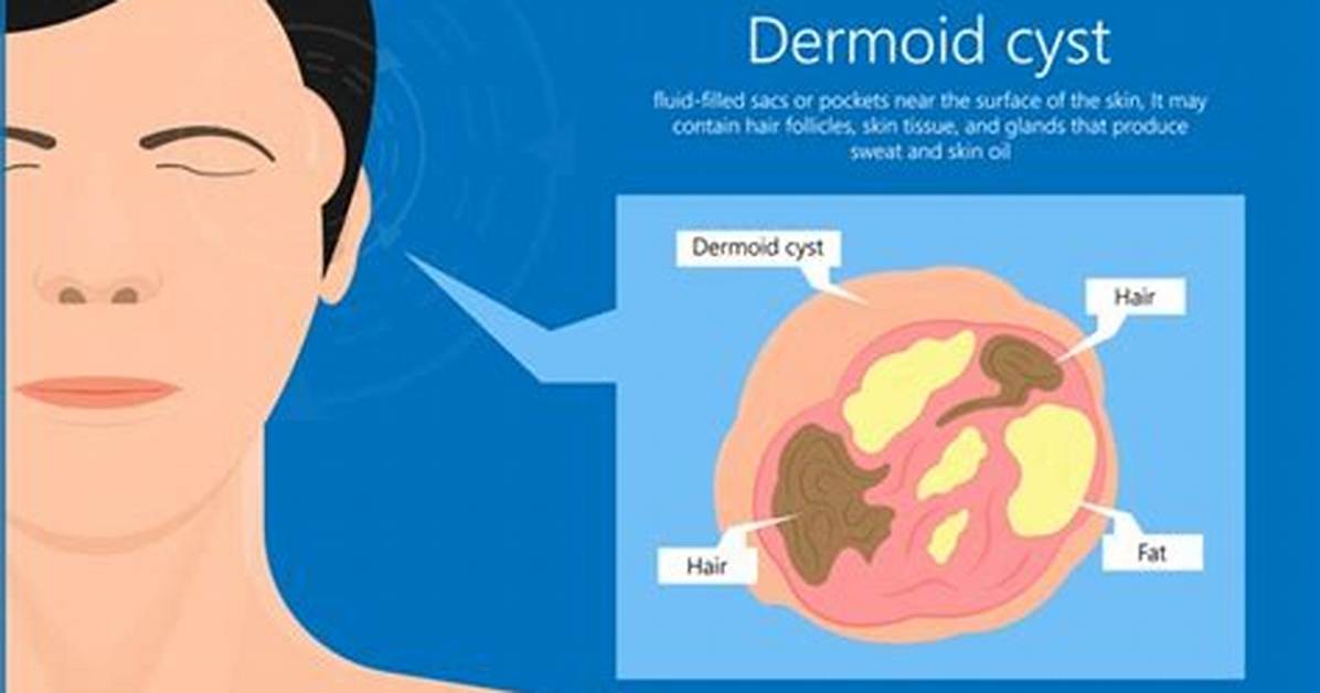 Can Dermoids Come Back?