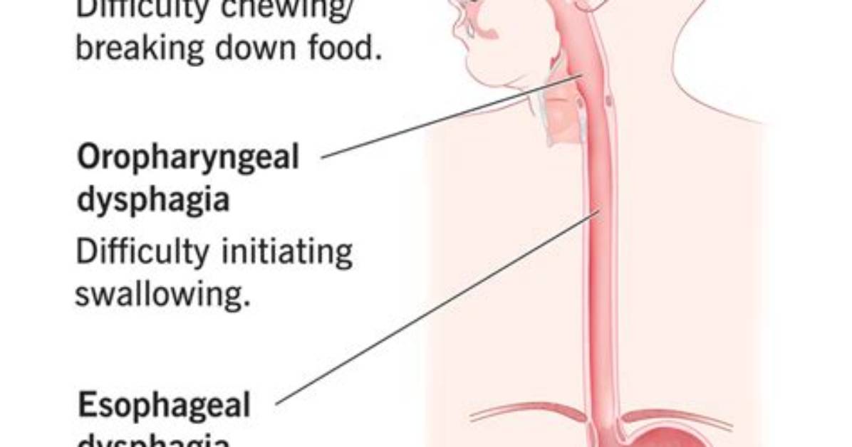 Can Difficulty Swallowing Go Away?