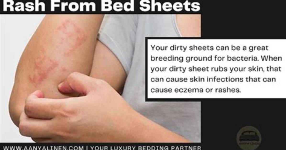 Can Dirty Sheets Cause Itching?