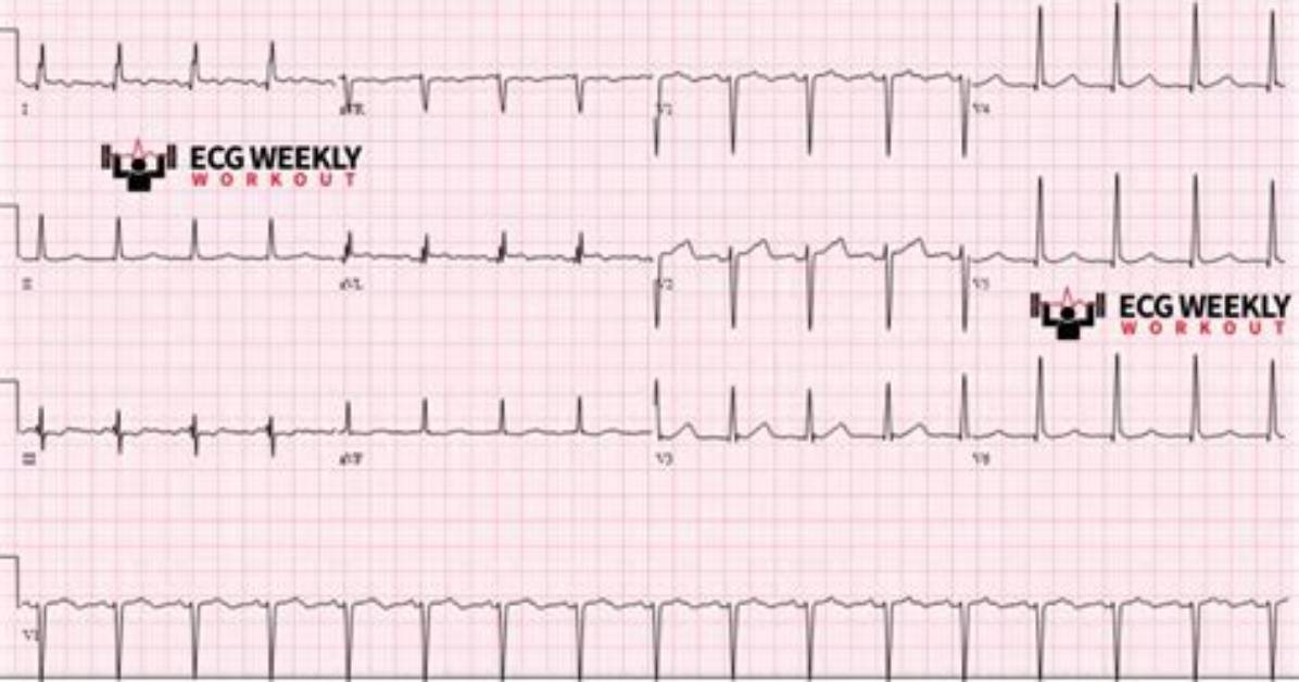 Can Ekg Detect Pe