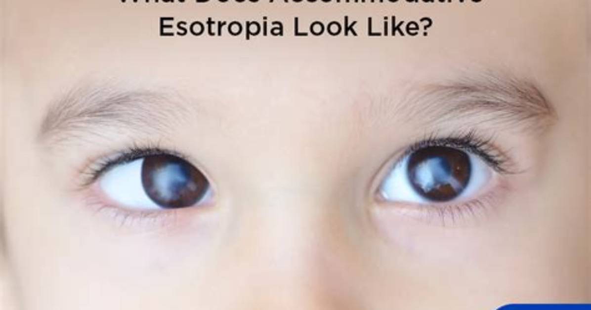 Can Esotropia Be Corrected