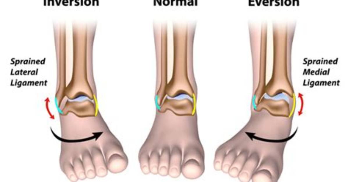 Can Eversion Cause Ankle Sprain?