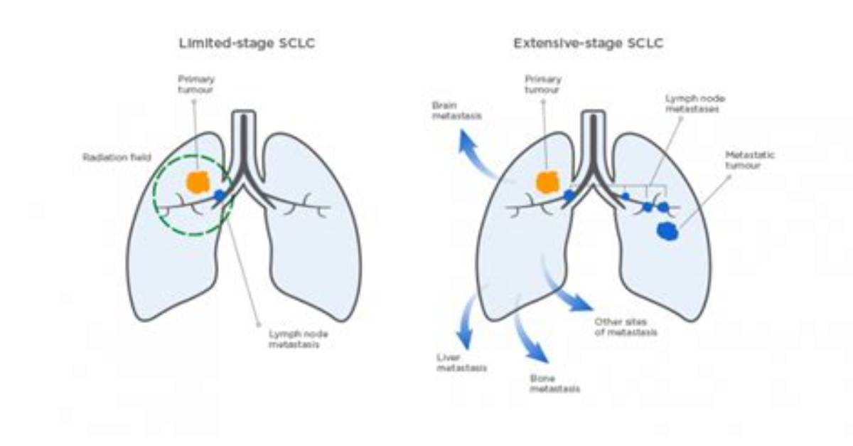 Can Extensive Stage Sclc Be Cured?