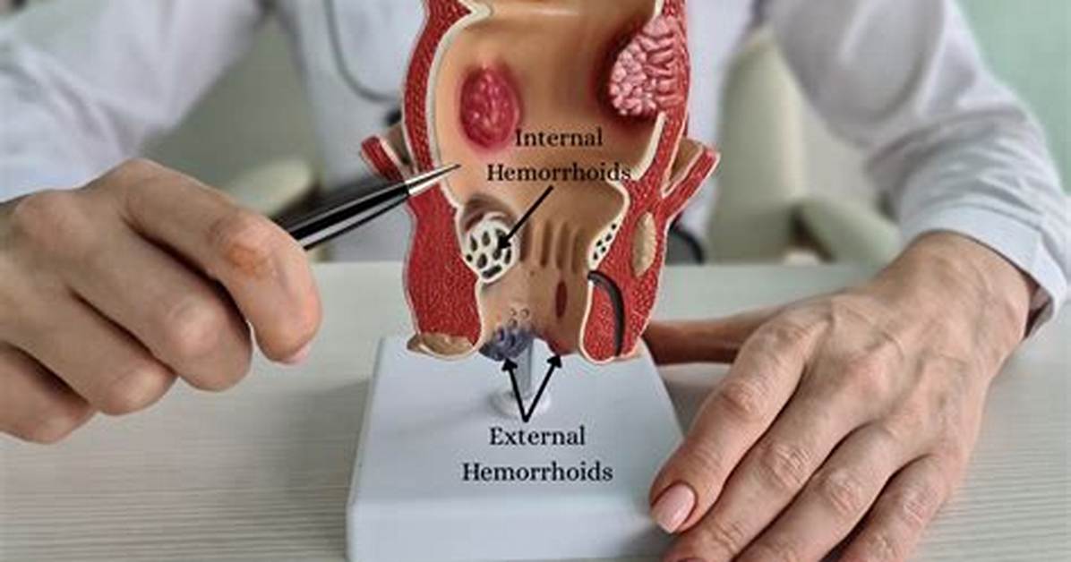 Can External Hemorrhoids Be Removed Without Surgery?